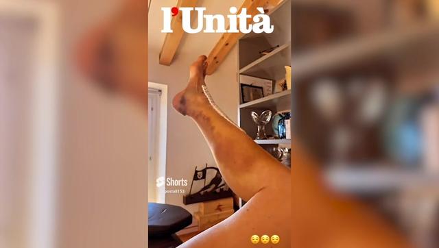 Sofia Goggia mostra la gamba dopo la frattura della tibia e l’operazione: “Meglio dai”